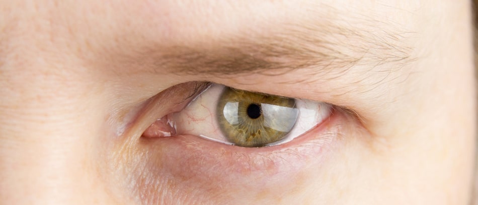 Droopy Eyelid can Impact Your Vision