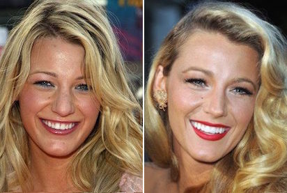 Discover The Best Celebrity Rhinoplasty Nose Jobs 