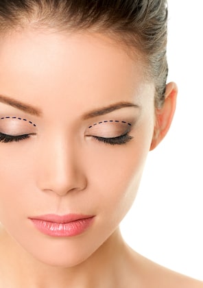 How Double Eyelid Surgery is Performed