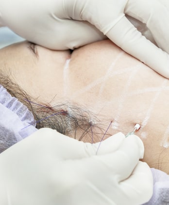 Thread Lift A New Non Invasive Treatment