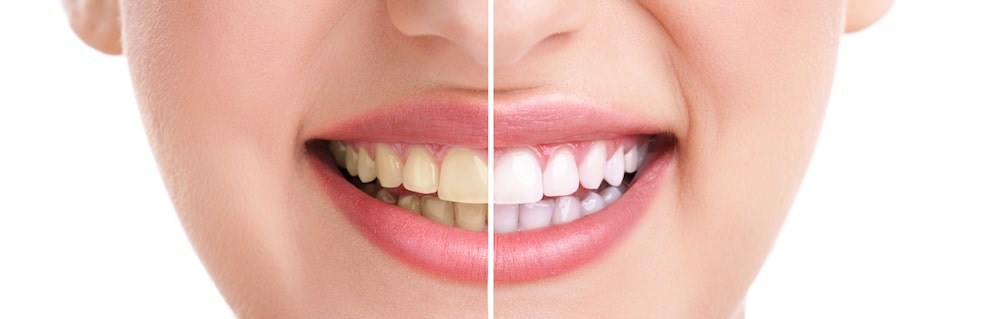 Learn all about zoom teeth whitening